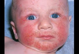 Eczema -DERMATITIS ATÓPICA-